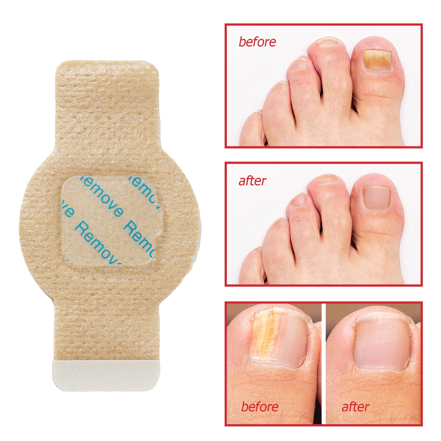 Fungal Nail Repair Patches
