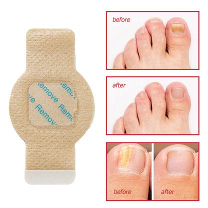 Fungal Nail Repair Patches